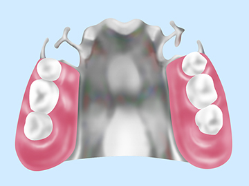 自費診療の入れ歯