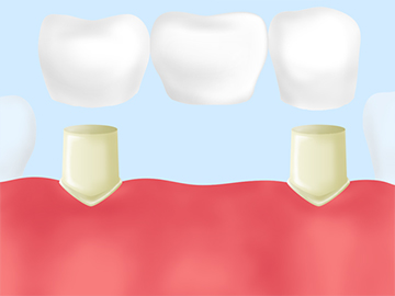 残っている歯にかける「ブリッジ」