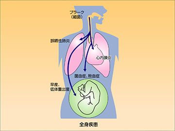 歯周病が全身に与える影響