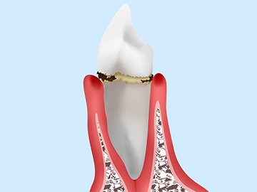 歯周病治療に悩みはありませんか？